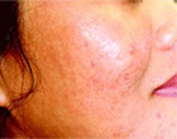 acne apres 1