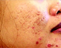 acne avant 1