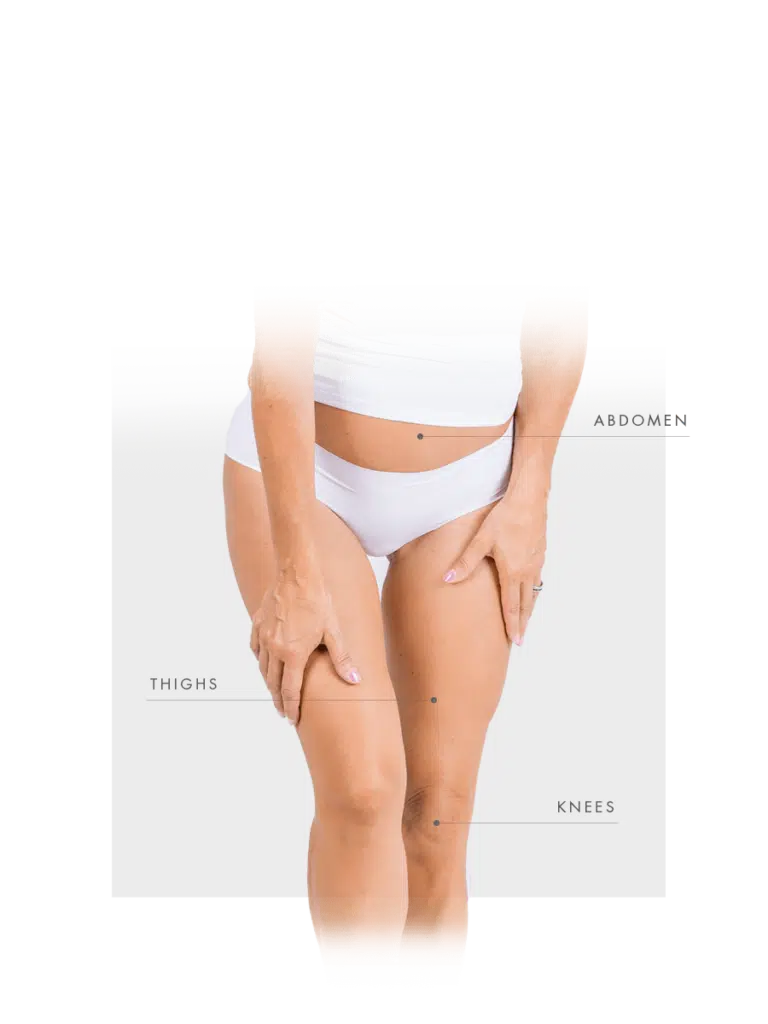 Microneedling for woman for abdomen, thighs and knees