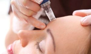 Microneedling treatment in Vancouver