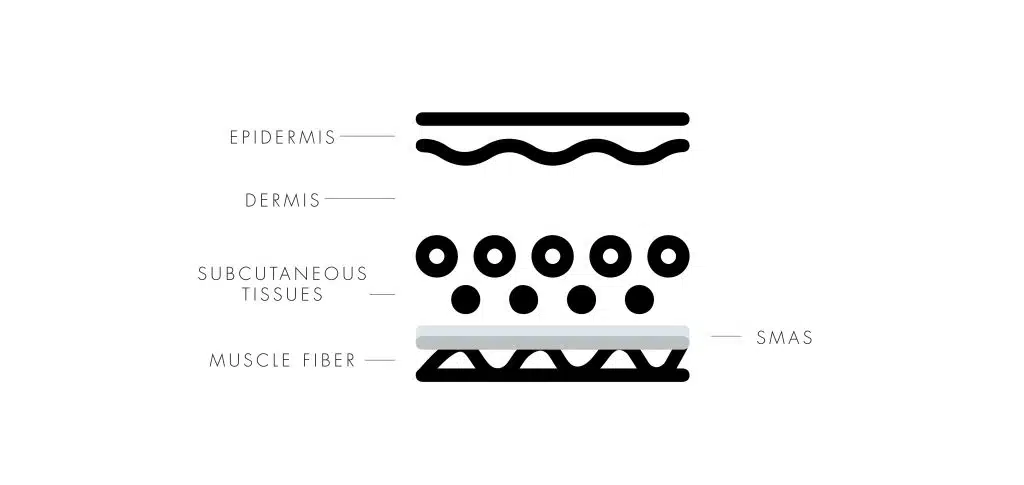 THERMAGE® VS. ULTHERA®: WHICH ONE IS RIGHT FOR YOU?